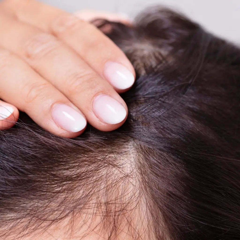 PRP Hair Restoration Before Care Access Clinic