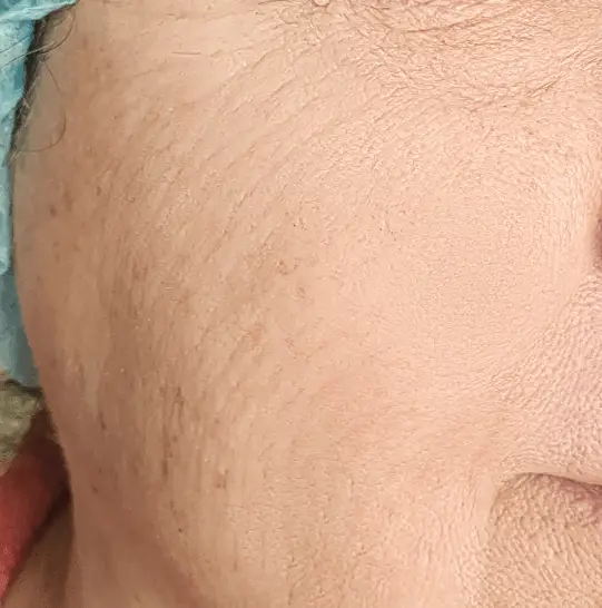 Microdermabrasion AFTER Care Access Clinic